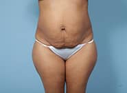 Before Image: Mesh Abdominoplasty - front