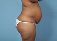 Before Image: Mesh Abdominoplasty - right-side