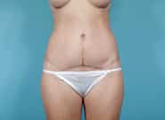 After Image: Mesh Abdominoplasty - front