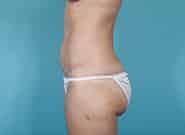 After Image: Mesh Abdominoplasty - left-side