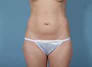 Before Image: Mesh Abdominoplasty - front