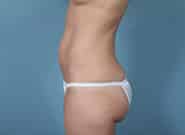 Before Image: Mesh Abdominoplasty - left-side