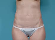 After Image: Mesh Abdominoplasty - front