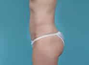 After Image: Mesh Abdominoplasty - left-side