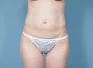 Before Image: Mesh Abdominoplasty - front