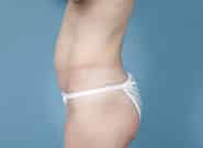 Before Image: Mesh Abdominoplasty - left-side