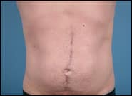 After Image: Midline Incisional Hernia Repair - front
