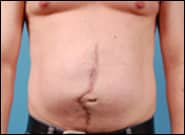 Before Image: Midline Incisional Hernia Repair - front