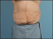 After Image: Midline Incisional Hernia Repair - front
