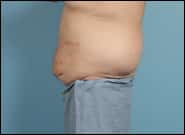 After Image: Midline Incisional Hernia Repair - left-side