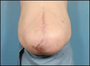 Before Image: Midline Incisional Hernia Repair - front