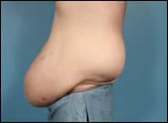 Before Image: Midline Incisional Hernia Repair - left-side