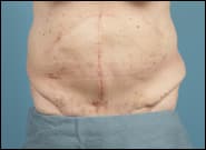 After Image: Midline Incisional Hernia Repair - front
