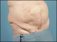 After Image: Midline Incisional Hernia Repair - right-front-oblique