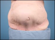 Before Image: Midline Incisional Hernia Repair - front