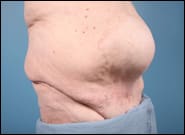 Before Image: Midline Incisional Hernia Repair - right-front-oblique