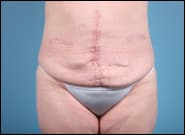 After Image: Midline Incisional Hernia Repair - front