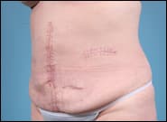 After Image: Midline Incisional Hernia Repair - left-front-oblique