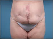 Before Image: Midline Incisional Hernia Repair - front