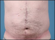 After Image: Midline Incisional Hernia Repair - front