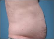 After Image: Midline Incisional Hernia Repair - right-side