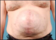 Before Image: Midline Incisional Hernia Repair - front