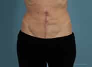 After Image: Midline Incisional Hernia Repair - front