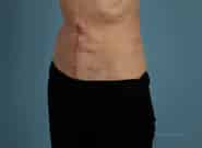 After Image: Midline Incisional Hernia Repair - left-front-oblique