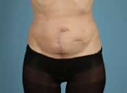 Before Image: Midline Incisional Hernia Repair - front