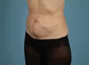 Before Image: Midline Incisional Hernia Repair - left-front-oblique