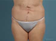 After Image: Midline Incisional Hernia Repair - front