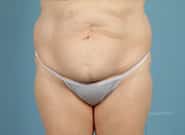 Before Image: Midline Incisional Hernia Repair - front