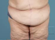 After Image: Midline Incisional Hernia Repair - front