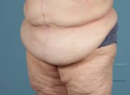 After Image: Midline Incisional Hernia Repair - left-front-oblique