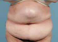 Before Image: Midline Incisional Hernia Repair - front