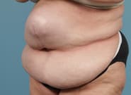 Before Image: Midline Incisional Hernia Repair - left-front-oblique