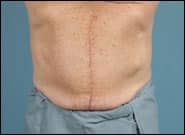 After Image: Midline Incisional Hernia Repair - front