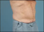 After Image: Midline Incisional Hernia Repair - right-front-oblique