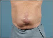Before Image: Midline Incisional Hernia Repair - front