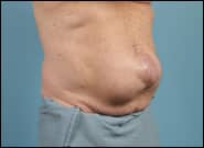 Before Image: Midline Incisional Hernia Repair - right-front-oblique