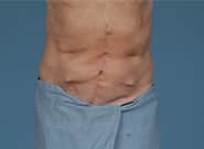 After Image: Midline Incisional Hernia Repair - front
