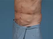 After Image: Midline Incisional Hernia Repair - left-front-oblique