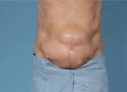 Before Image: Midline Incisional Hernia Repair - front