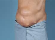 Before Image: Midline Incisional Hernia Repair - left-front-oblique