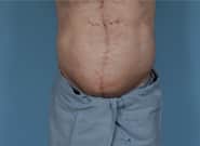 After Image: Midline Incisional Hernia Repair - front