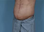 After Image: Midline Incisional Hernia Repair - left-front-oblique