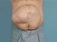 Before Image: Midline Incisional Hernia Repair - front