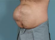 Before Image: Midline Incisional Hernia Repair - left-front-oblique