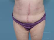 After Image: Midline Incisional Hernia Repair - front
