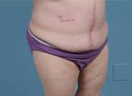 After Image: Midline Incisional Hernia Repair - right-front-oblique